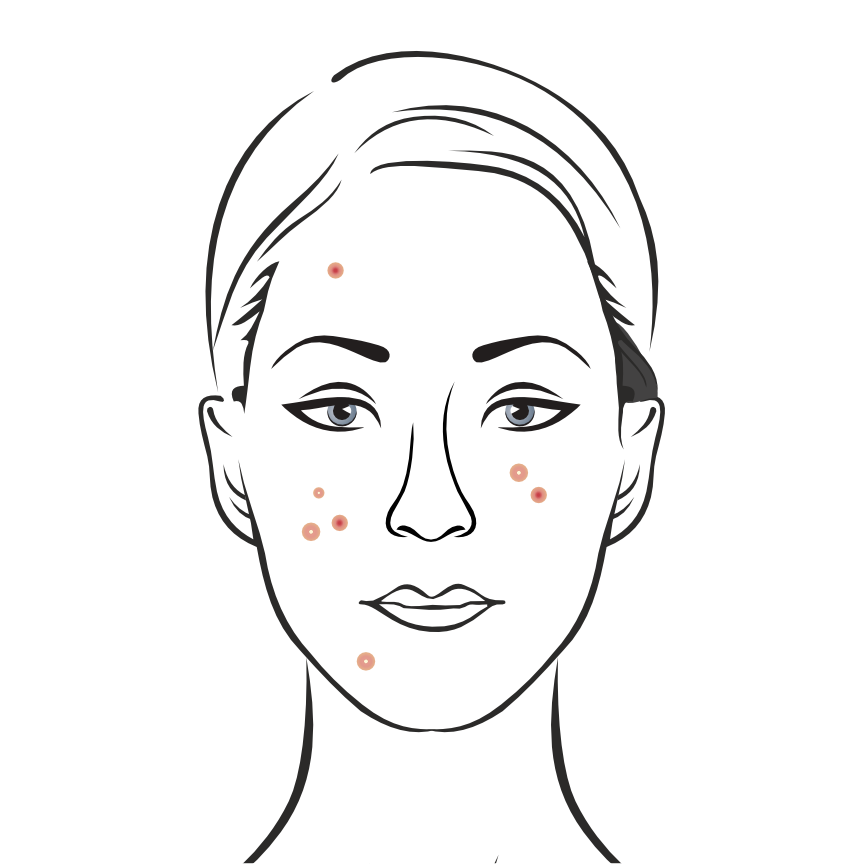 acne-female