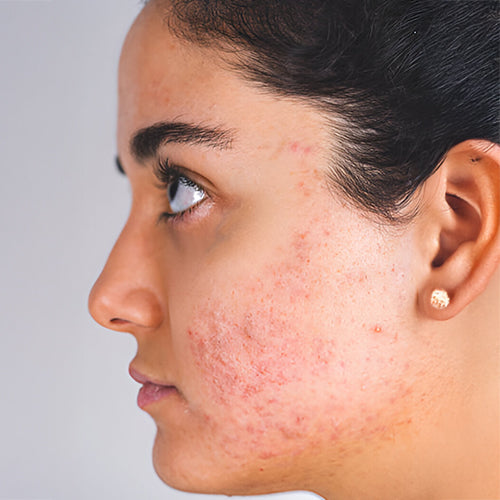 Anti-Acne Routine