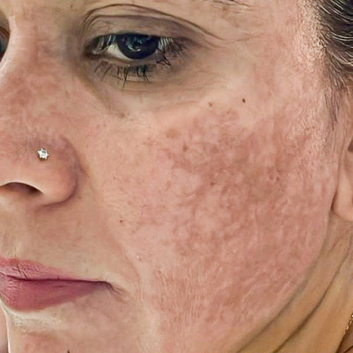 Anti-Pigmentation Routine